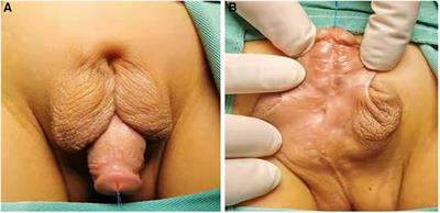 Evaluation of tunica vaginalis flap-covering combined with modified Glenn–Anderson in one-stage repair of proximal hypospadias with incomplete penoscrotal transposition